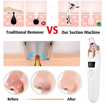 Electric Blackhead Remover – Rechargeable Facial Pore Vacuum Cleaner with 6 Suction Heads