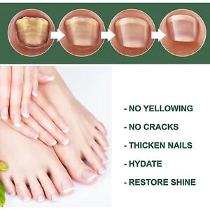 Foot Cure Nail Fungus Treatment Oil – All-Natural Antimicrobial Formula for Finger & Toenail Care
