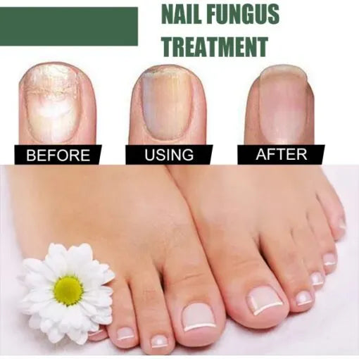 Foot Cure Nail Fungus Treatment Oil – All-Natural Antimicrobial Formula for Finger & Toenail Care