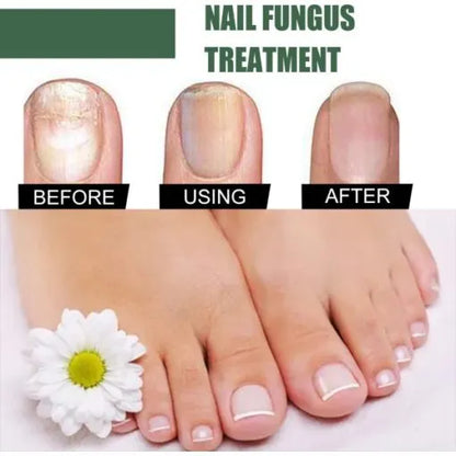 Foot Cure Nail Fungus Treatment Oil – All-Natural Antimicrobial Formula for Finger & Toenail Care