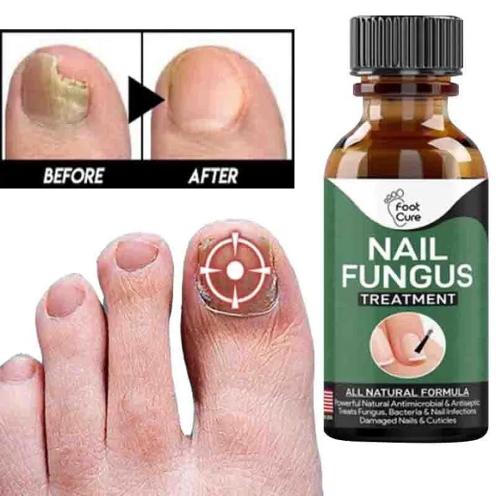 Foot Cure Nail Fungus Treatment Oil – All-Natural Antimicrobial Formula for Finger & Toenail Care
