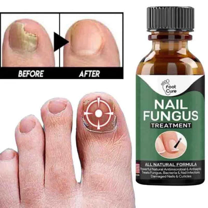 Foot Cure Nail Fungus Treatment Oil – All-Natural Antimicrobial Formula for Finger & Toenail Care
